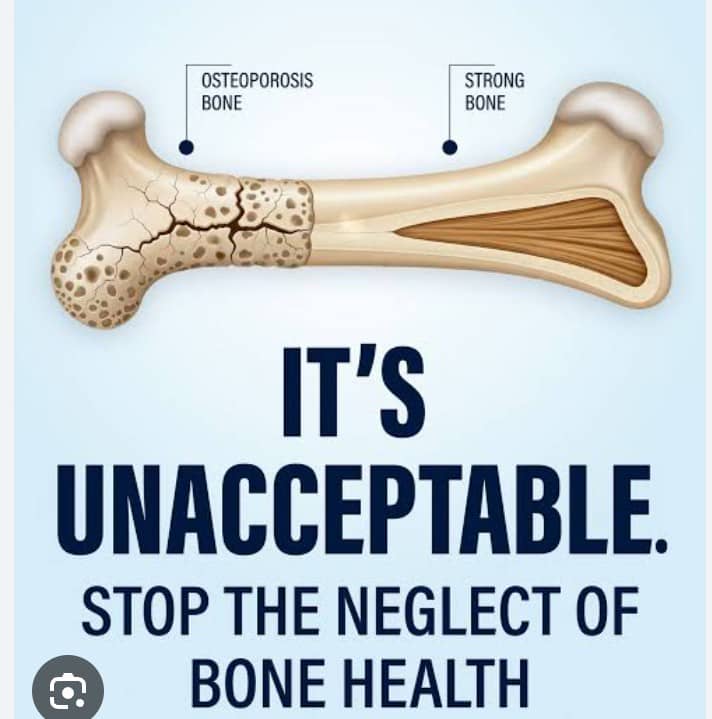 POOR DIET, SEDENTARY LIVING LINKED TO BONE FRAGILITY, SPECIALISTS CAUTION.