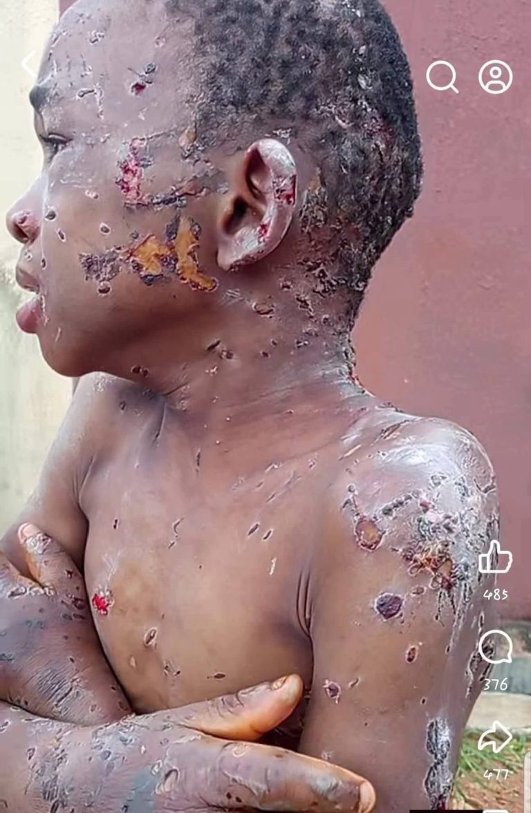 ANAMBRA GOVERNMENT INTERVENES AS ABUSED 10-YEAR-OLD BOY RECEIVES TREATMENT IN ONITSHA